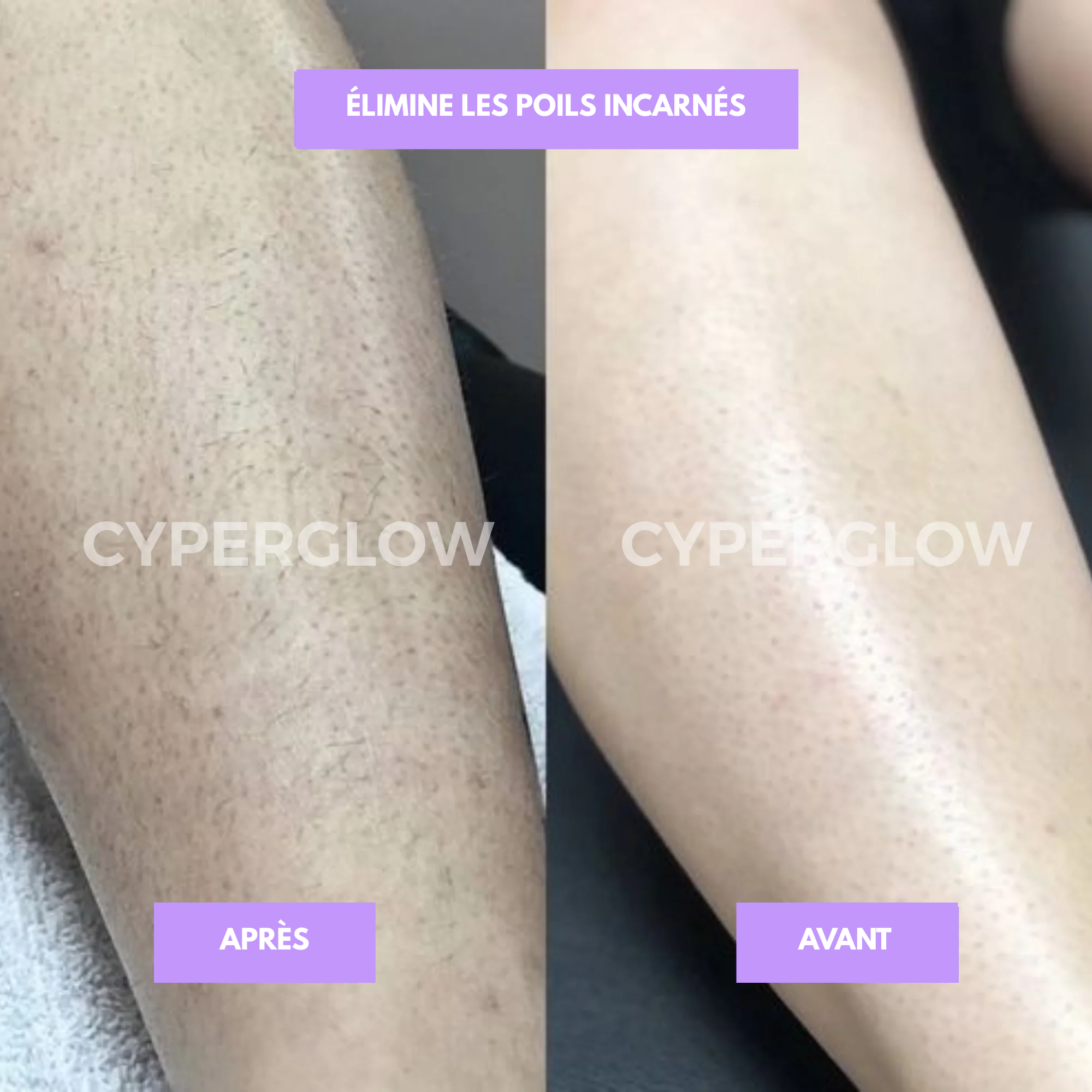 Cyperus - disparition définitve des poils !